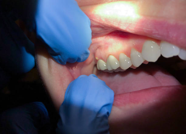 Best Emergency Cosmetic Dentistry (e.g., broken veneers) in Whiskey Creek, FL